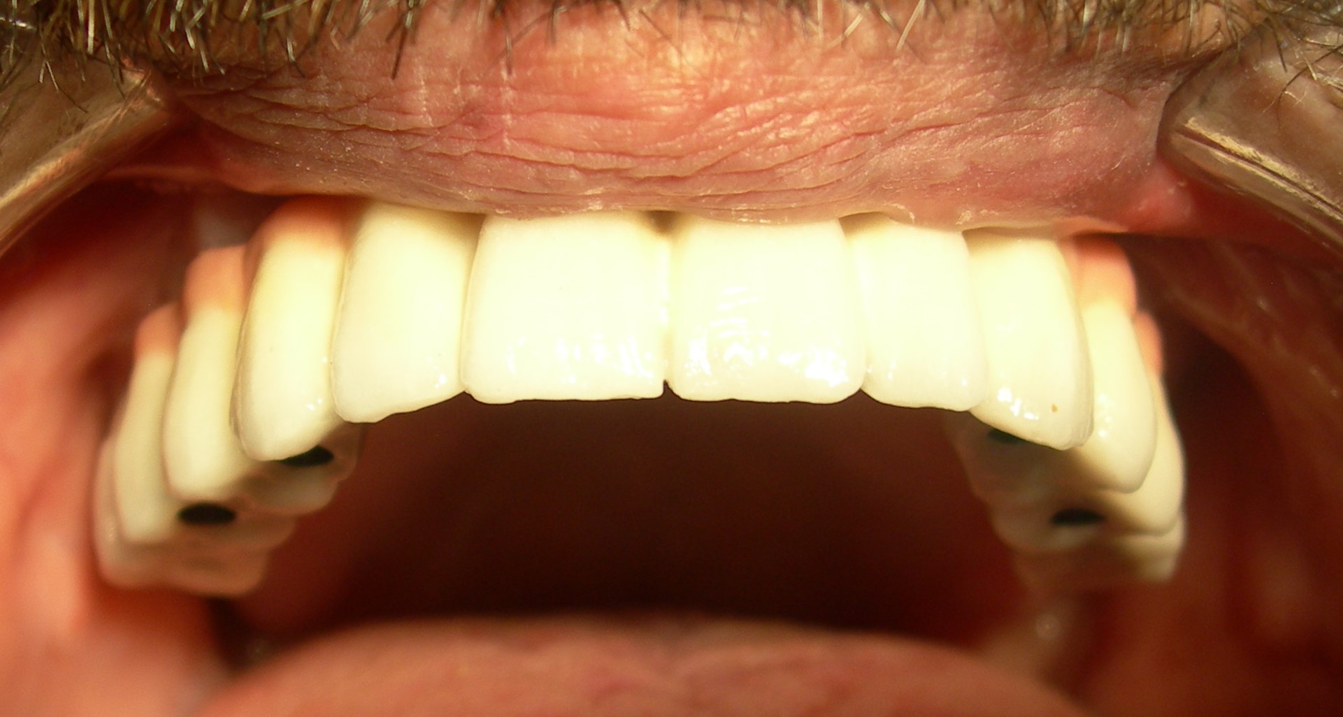 İmplant Vidalı Sistem Sonrası